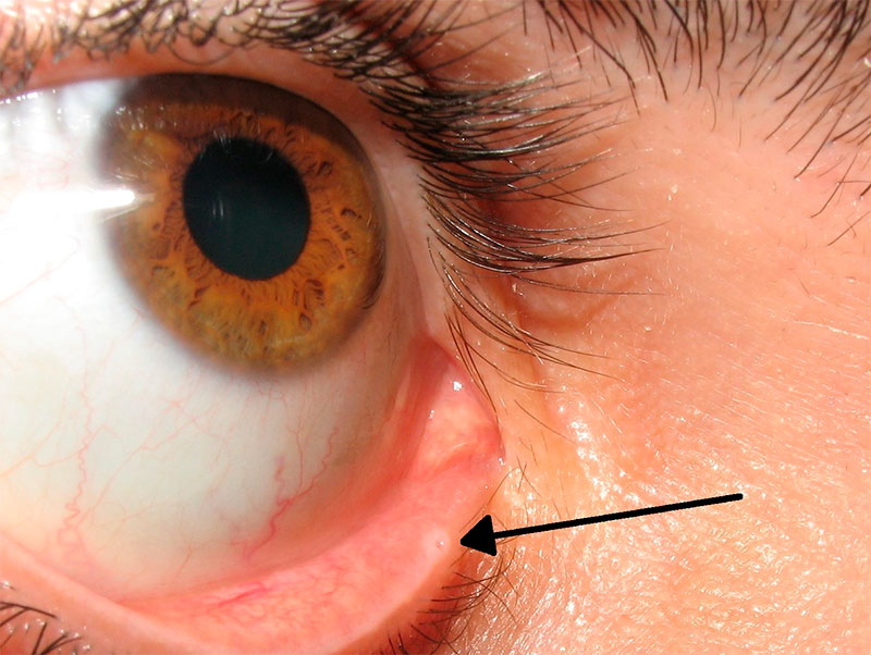 Foto cirurgia: Vias Lacrimais