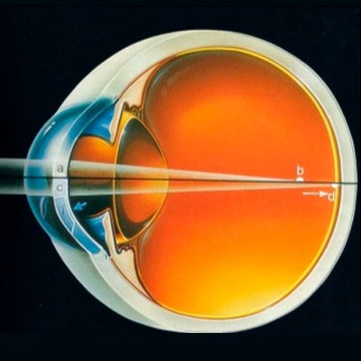 Ametropia