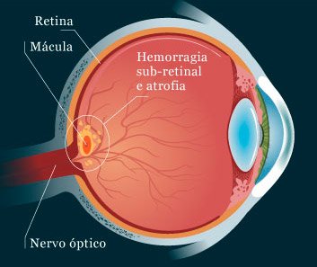 Degeneração Macular Relacionada à Idade (DMRI)