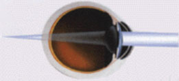Hipermetropia