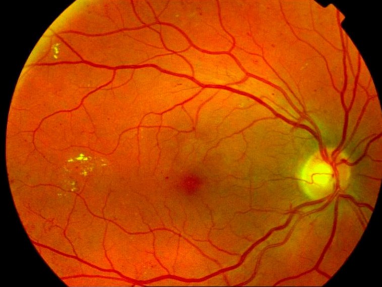 Retinopatia Diabética
