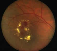 Retinopatia