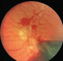 Retinopatia