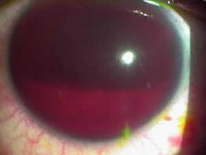 Trauma Ocular