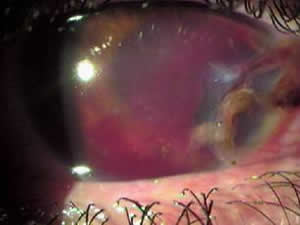 Trauma ocular